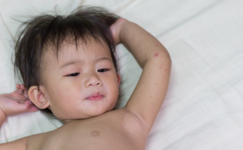 hand foot and mouth disease in kids