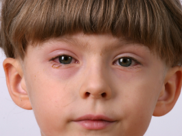 remedies for conjunctivitis