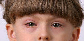 remedies for conjunctivitis