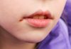 mouth ulcers in children