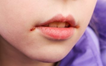 mouth ulcers in children