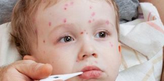 Summer Diseases in Children