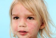 papular rash child