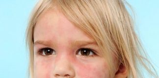 papular rash child