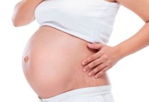 home remedy for stretch marks