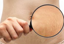 home remedy for stretch marks