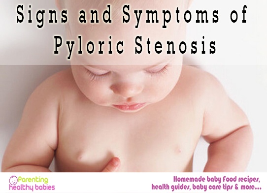 Pyloric Stenosis