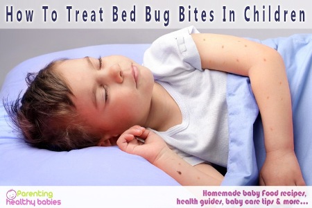 Treat Bed Bug Bites