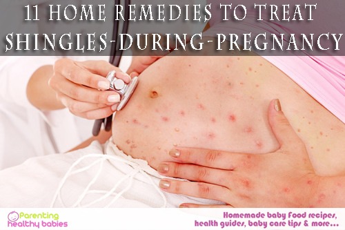shingles during pregnancy