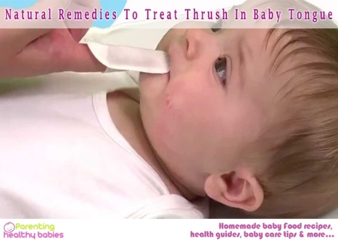 Treat Thrush In Baby Tongue