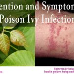 Poison Ivy Infection: Symptoms, prevention and home remedy