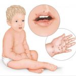 remedies for treating hand and mouth disease in children