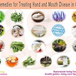 remedies for treating hand and mouth disease in children