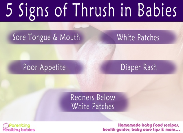 Thrush in Babies