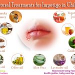 11 natural treatments for impetigo in Children