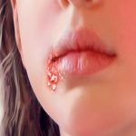11 natural treatments for impetigo in Children