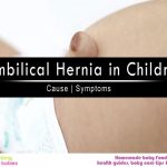 Umbilical Hernia in Children