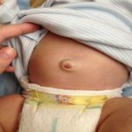 Umbilical Hernia in Children