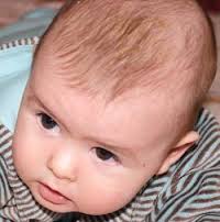 cradle cap