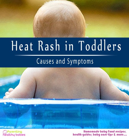 Heat Rash in Toddlers