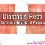 Diastasis Recti- A common side effect of pregnancy