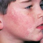 7 Home remedies to treat ‘Fifth Disease’ in children