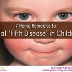 7 Home remedies to treat ‘Fifth Disease’ in children