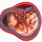 6 Causes for low amniotic fluid: Oligohydramnios