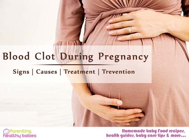 Blood Clot During Pregnancy