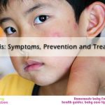 15 Easy Ways to Treat Bug Bites in Children