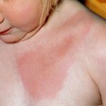 11 Lyme disease symptoms in children
