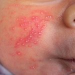 Neonatal Candida Infection: 11 Natural Remedies