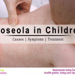 Roseola in Children: Causes, Symptoms and Treatment