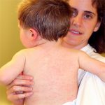 Roseola in Children: Causes, Symptoms and Treatment