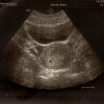 Week 3 of Pregnancy: Pregnancy Week By Week