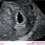 Week 5 of pregnancy: Pregnancy week by week