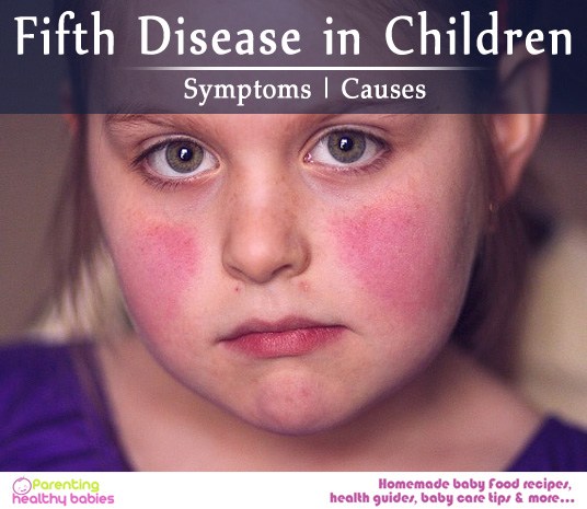 fifth disease in children
