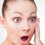 11 Home Remedies for Teen Acne