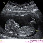 WEEK 12 OF PREGNANCY – PREGNANCY WEEK BY WEEK