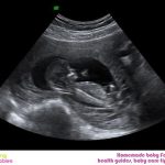 Week 13 of Pregnancy – Pregnancy Week by Week
