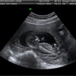 Week 13 of Pregnancy – Pregnancy Week by Week