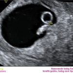 Week 6 of pregnancy: Pregnancy week by week