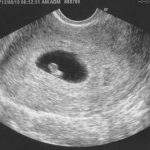 Week 6 of pregnancy: Pregnancy week by week