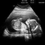 Week 7 of pregnancy: pregnancy week by week