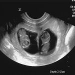 WEEK 9 OF PREGNANCY – PREGNANCY WEEK BY WEEK