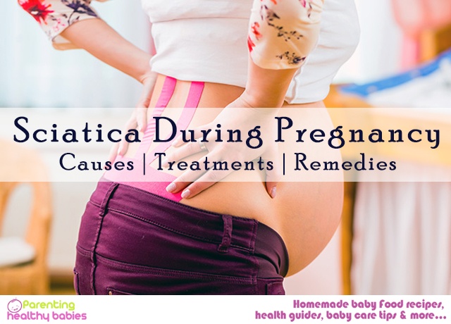 Sciatica During Pregnancy