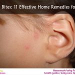 Spider bites: 11 effective home remedies for kids