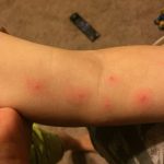 Spider bites: 11 effective home remedies for kids