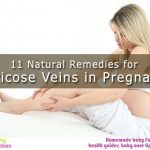 11 natural remedies for dealing with varicose veins during pregnancy