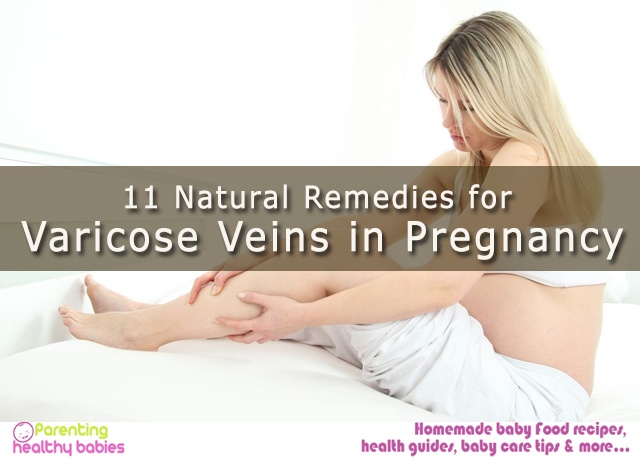 Varicose Veins
